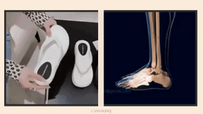 Chinelo Ortopédico para Fascite Plantar